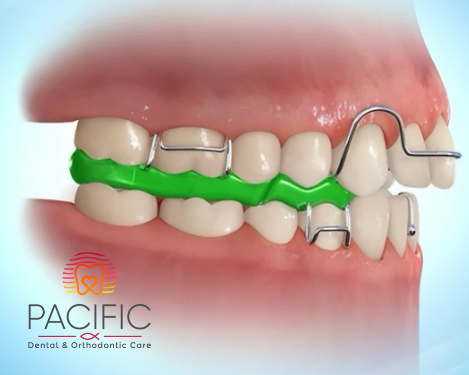 Fun Rubber Band Colors For Braces - PDOC